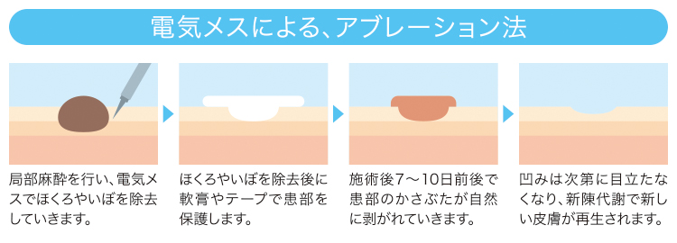 アブレーション法_説明図