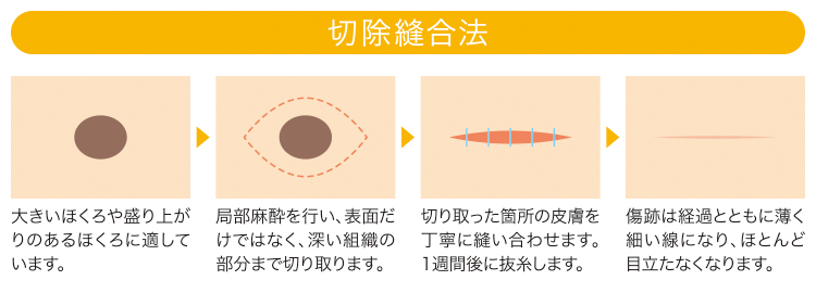 切除縫合法_説明図