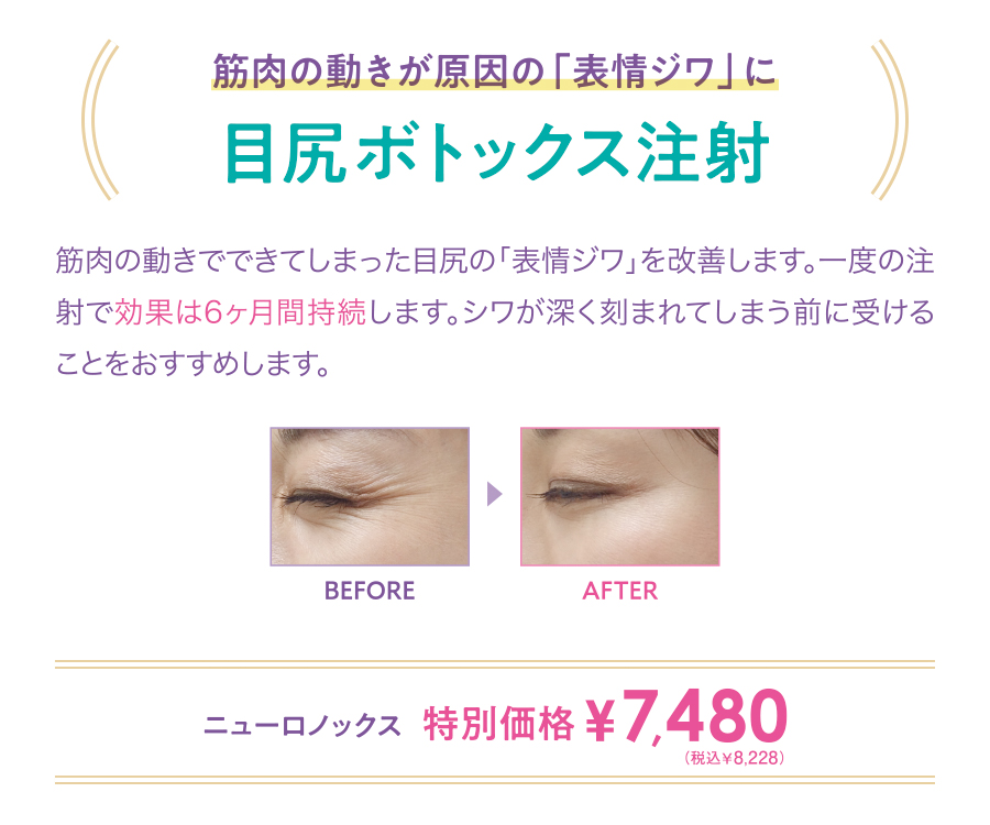 目尻ボトックス注射